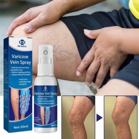 Varicose Veins Spray!!